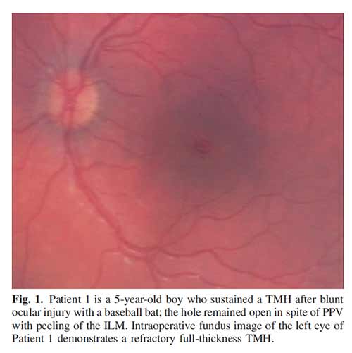 5 year old boy, traumatic macular hole