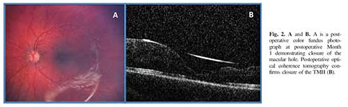 5 year old boy, traumatic macular hole