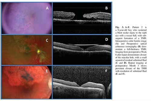 5 year old boy, traumatic macular hole