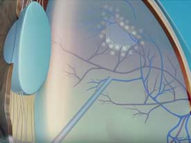 patient education, video, dry amd