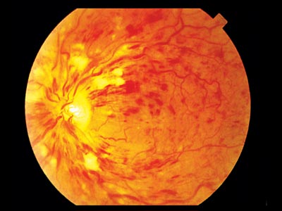 crvo, central, retinal, vein, occlusion