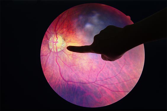 vitreo retina diseases, retina eye